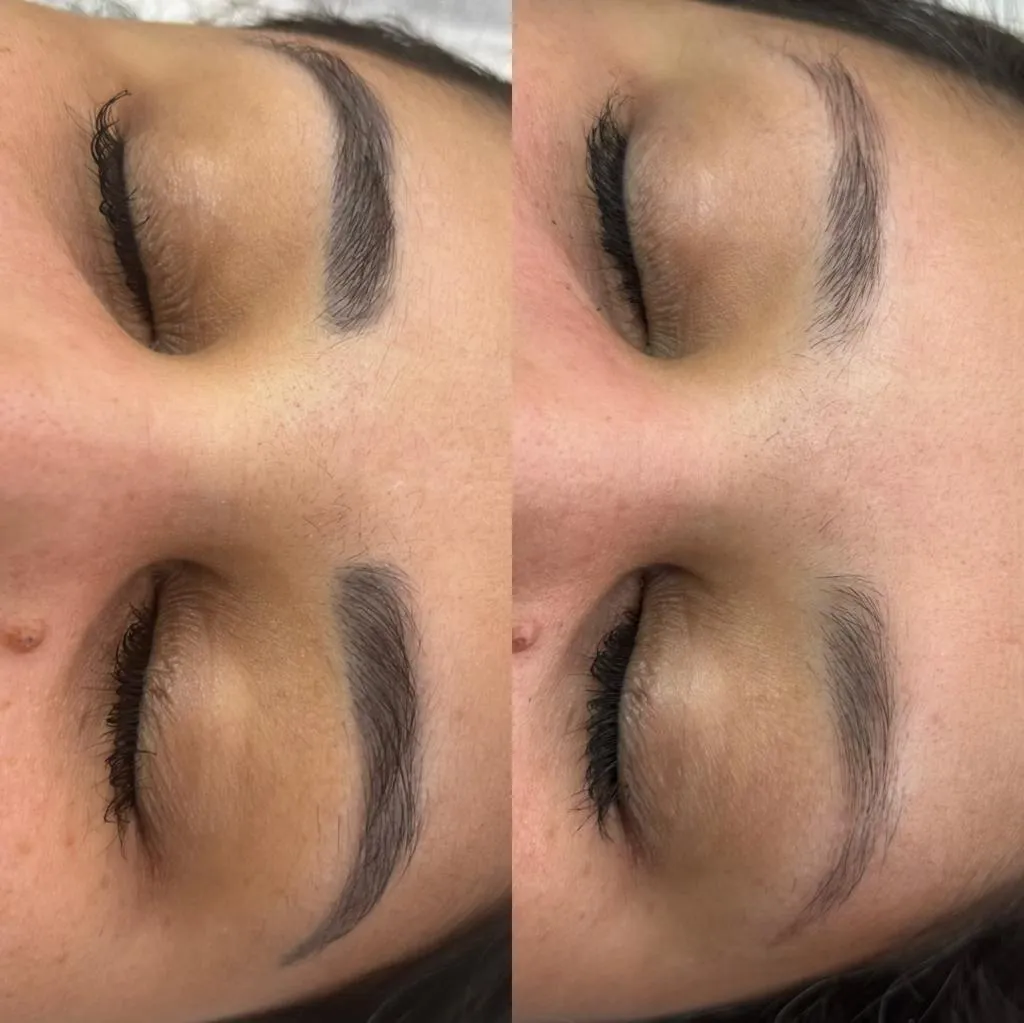 Antes e depois — sobrancelha