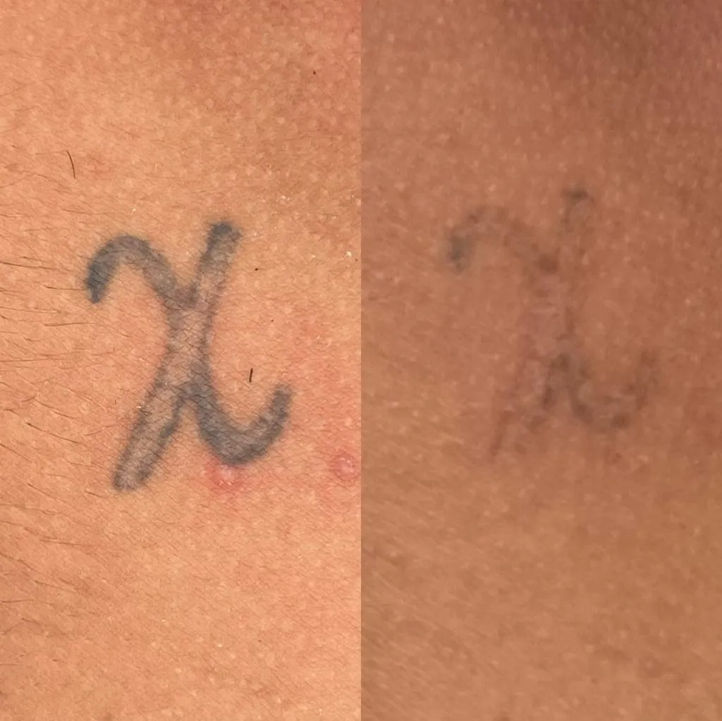 Antes e depois — tatuagem