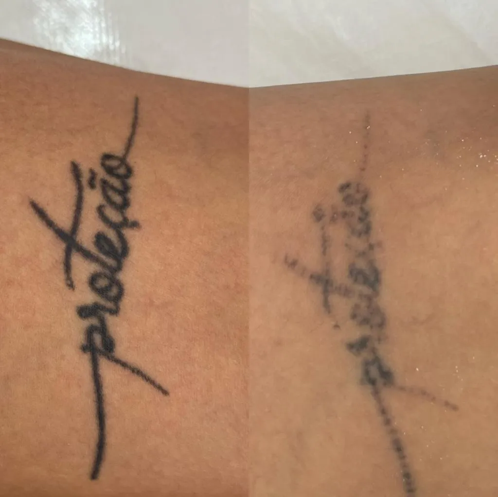 Antes e depois — tatuagem
