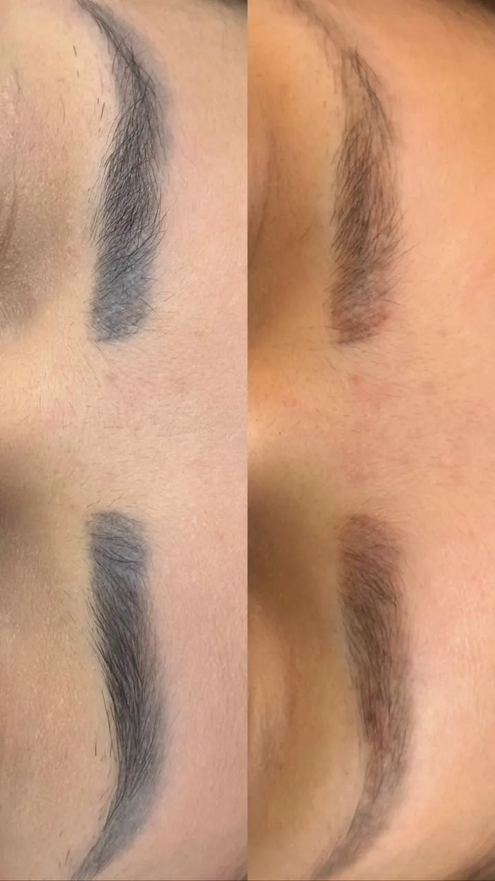 Antes e depois — sobrancelha