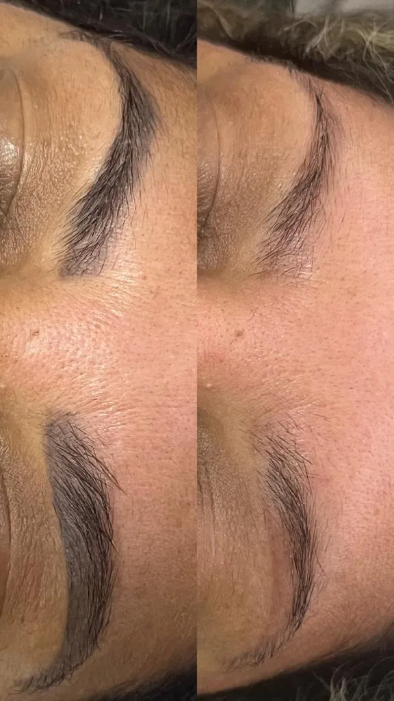 Antes e depois — sobrancelha